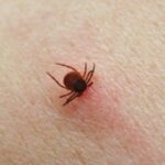 Tick attached to human skin