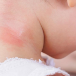 Child with Mosquito Bite on Neck