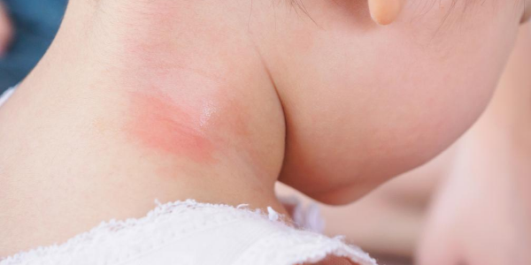 Child with Mosquito Bite on Neck