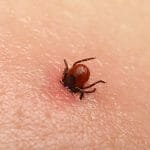 Tick bite