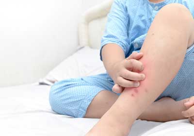 Child itching bug bites on exposed leg