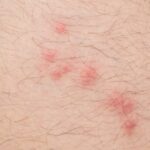flea bites on skin